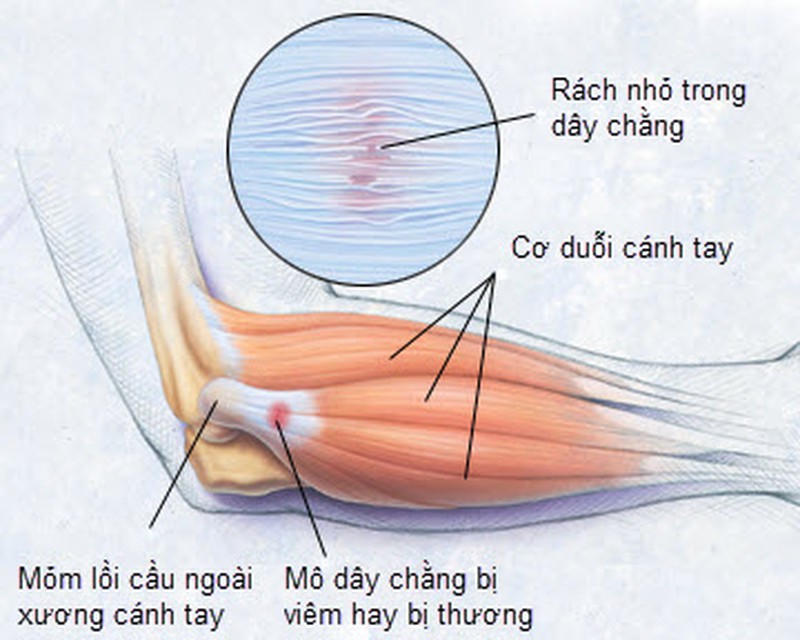 Cách xử lý chấn thương đánh cầu lông bị đau khủy tay